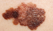 Così il melanoma si difende dai farmaci 