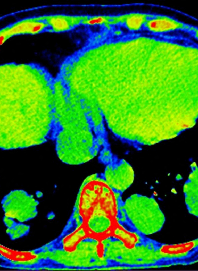 Scoperti i meccanismi chiave dell'origine delle metastasi