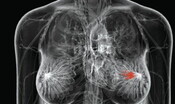 Cancro al seno, con l'IA meno trattamenti chemioterapici inutili 